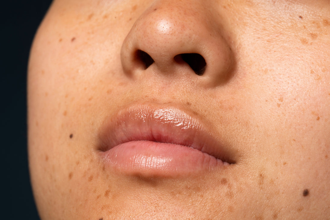 Dark spots and hyperpigmentation